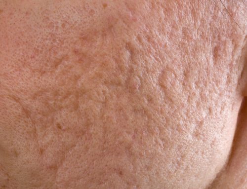 ¿qué es eso del LUPUS? ¿la fisioterapia puede hacer algo?