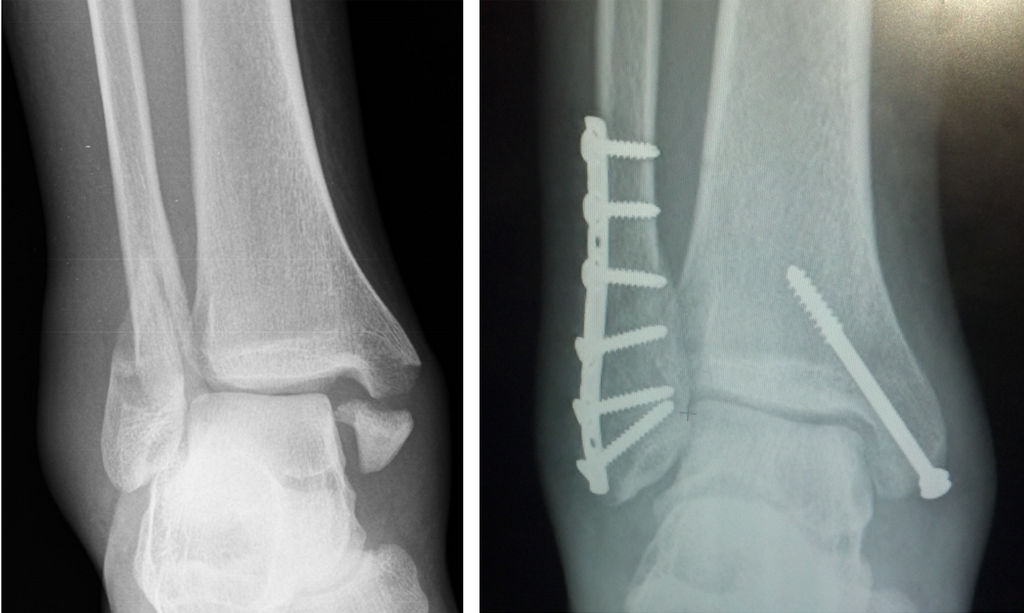 Tratamiento de fisioterapia para una fractura de tobillo