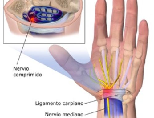 Síndrome del túnel carpiano: Qué es y cómo tratarlo