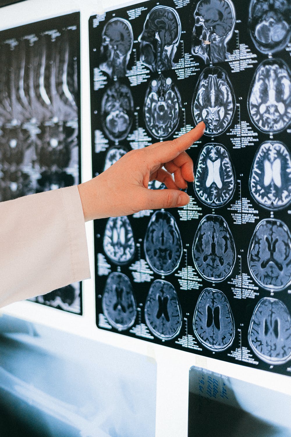 alzheimer-parkinson