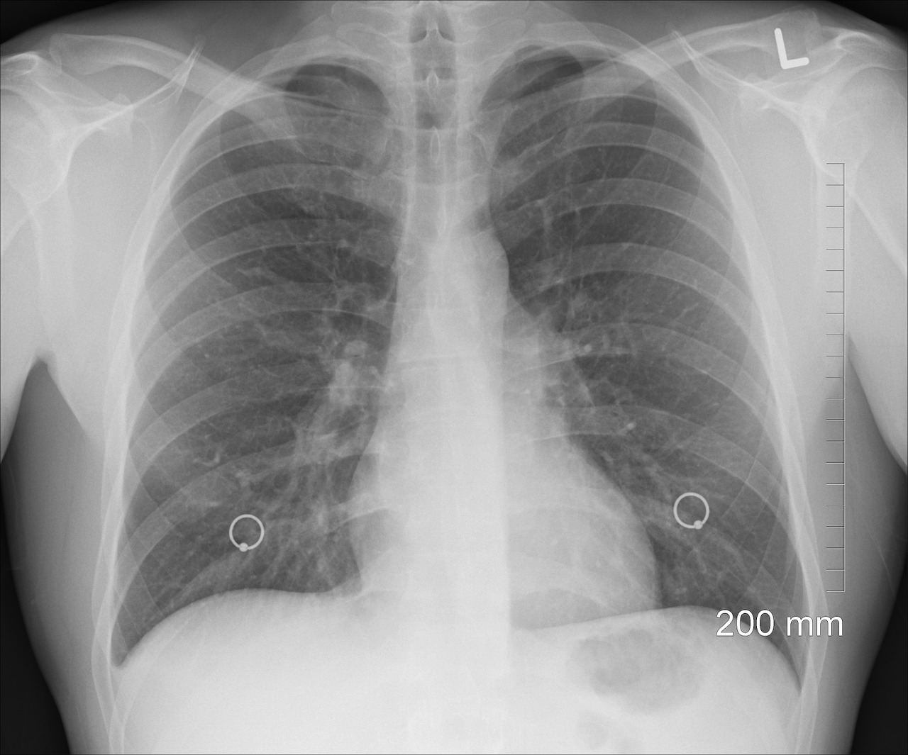 fisioterapia-respiratoria