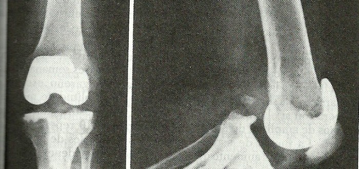 Prótesis de rodilla