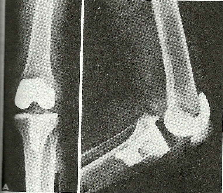 Prótesis de rodilla