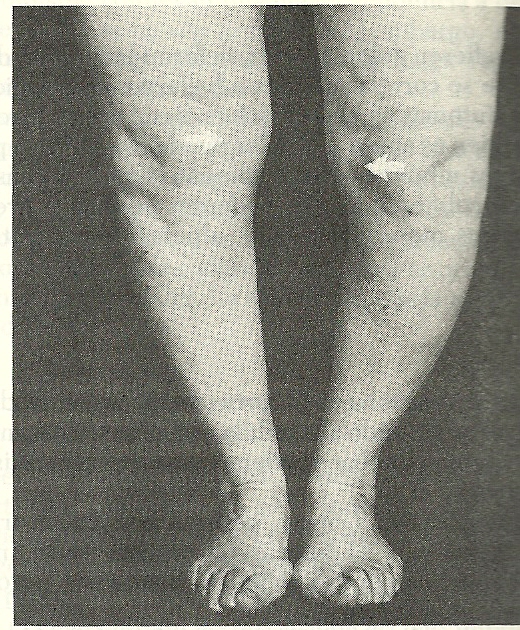 Osteoartrosis de rodilla