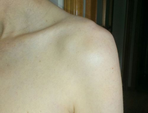Fisioterapia en la luxación de hombro