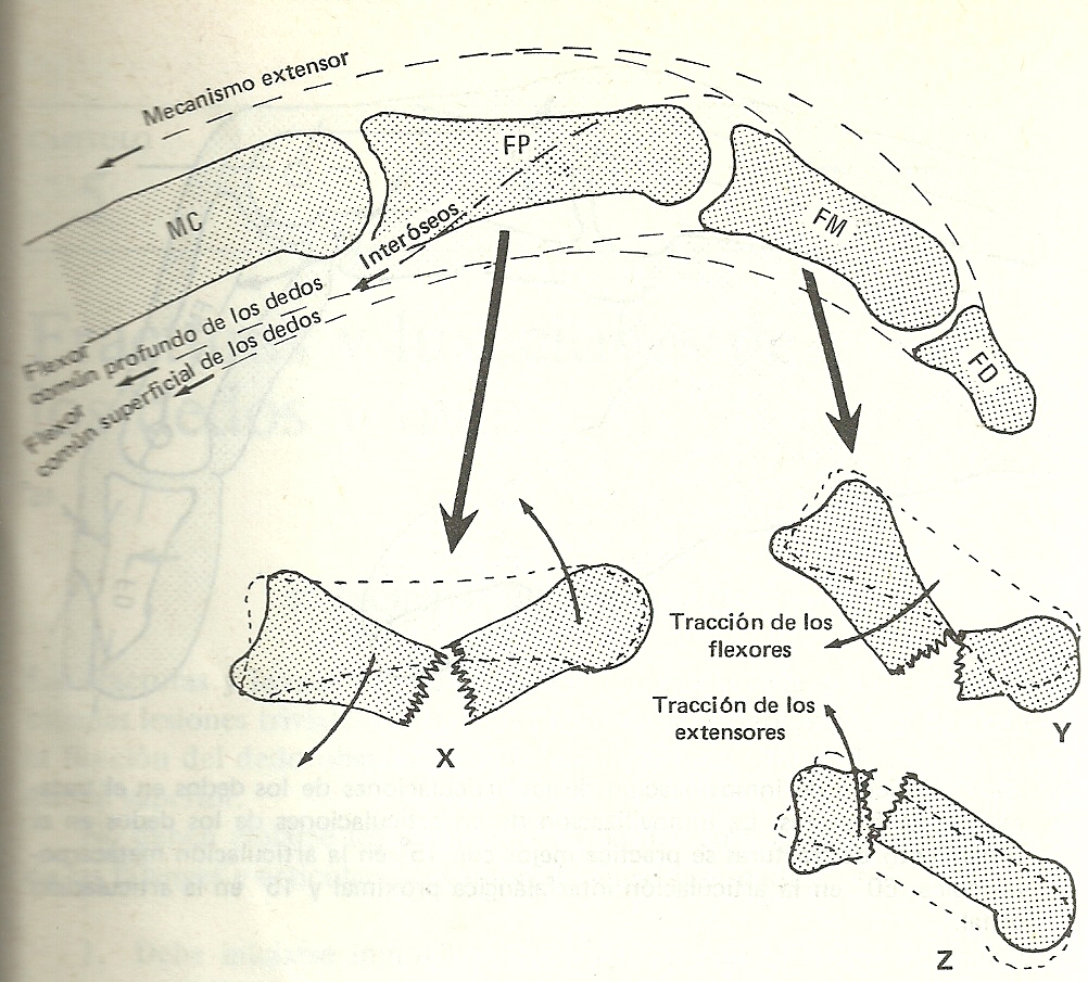 Tratamiento de fisioterapia para las fracturas de la mano - San ...