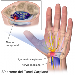 carpal_tunnel_syndrome-es