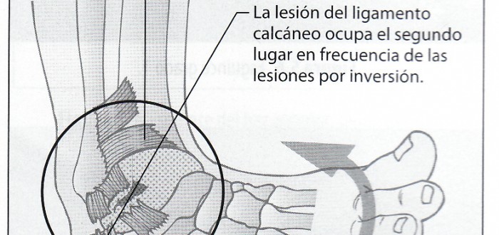esguince-tobillo