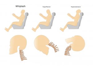 mecanismo habitual del latigazo cervical. 