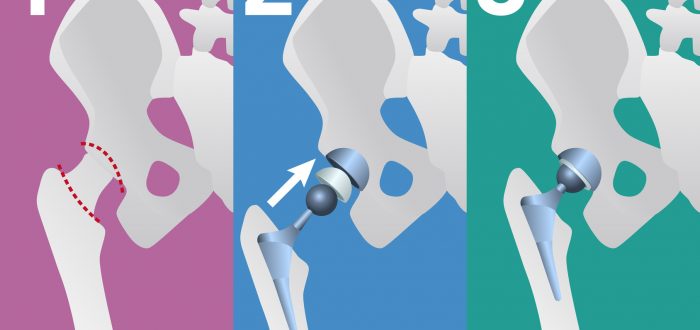 fases de una prótesis de cadera