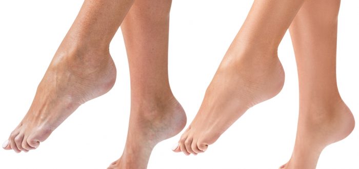 Woman’s dry feet before and after treatment.