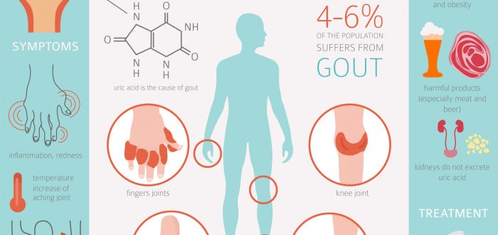 Joints diseases. Gout symptoms, treatment icon set. Medical infographic design