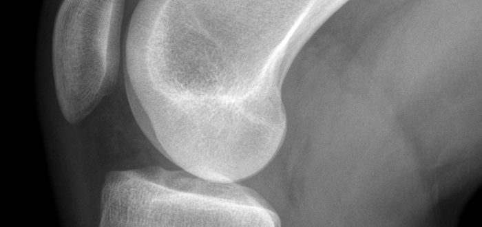 rodilla